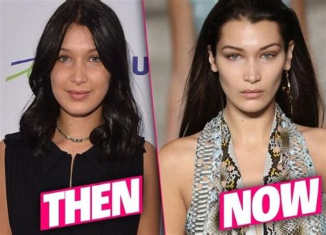 bella hadid eye surgery.